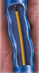 ClosureFast-Venefit Katheter in Vene