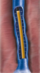 ClosureFast-Venefit Wärmeabgabe