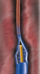 ClosureFast-Venefit Ergebnis